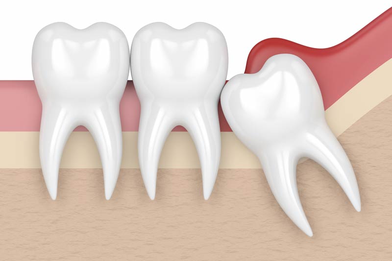 Wisdom Tooth Removal in Fountain Valley